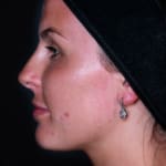 Before non-surgical rhinoplasty with nose contouring, addressing a nose bump