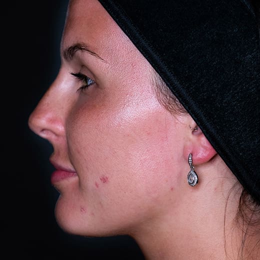 Before non-surgical rhinoplasty with nose contouring, addressing a nose bump
