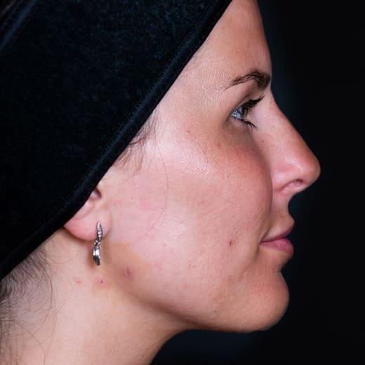 After non-surgical rhinoplasty with nose contouring, addressing a nose bump