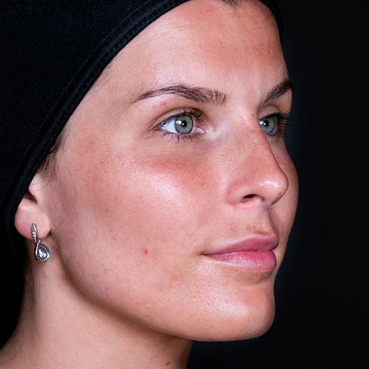 After non-surgical rhinoplasty with nose contouring, addressing a nose bump