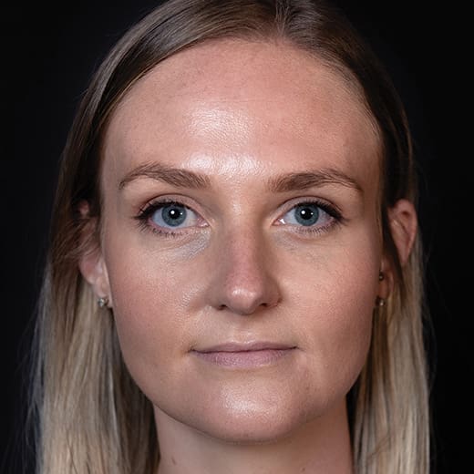 After tear trough filler, addressing dark circles under the eyes.