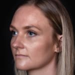 Before tear trough filler, addressing dark circles under the eyes.