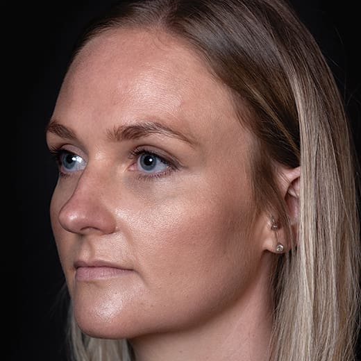 Before tear trough filler, addressing dark circles under the eyes.