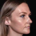 After tear trough filler, addressing dark circles under the eyes.