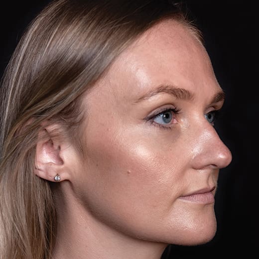 After tear trough filler, addressing dark circles under the eyes.