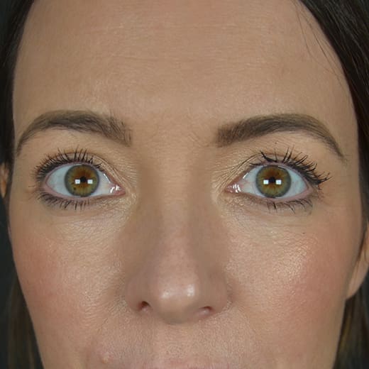After upper blepharoplasty (eyelid surgery), addressing heavy upper eyelids