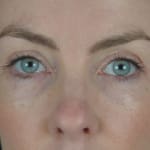 After upper blepharoplasty (eyelid surgery), addressing heavy upper eyelids