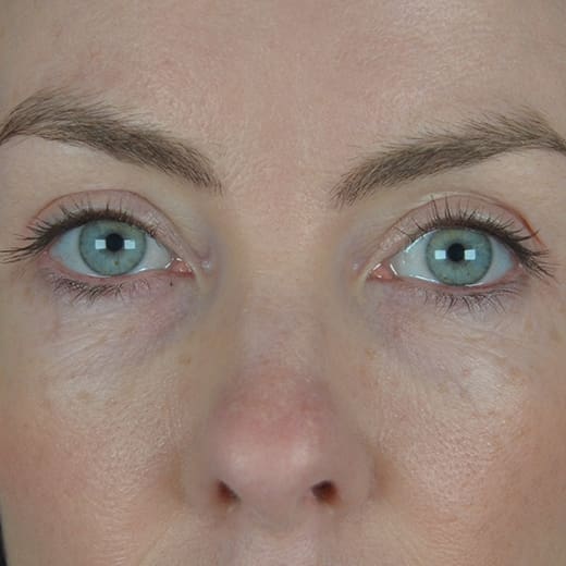 After upper blepharoplasty (eyelid surgery), addressing heavy upper eyelids