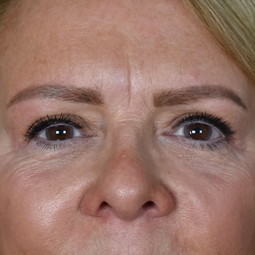 After upper blepharoplasty (eyelid surgery), addressing heavy upper eyelids