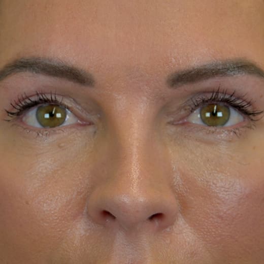 After upper blepharoplasty (upper eyelid surgery), addressing heavy upper eyelids.