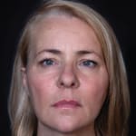 After volumetric facelift with cheek, chin, and jawline filler, addressing jowls.