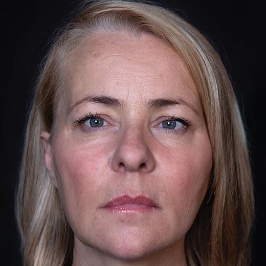 After volumetric facelift with cheek, chin, and jawline filler, addressing jowls.