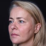 Before volumetric facelift with cheek, chin, and jawline filler, addressing jowls.