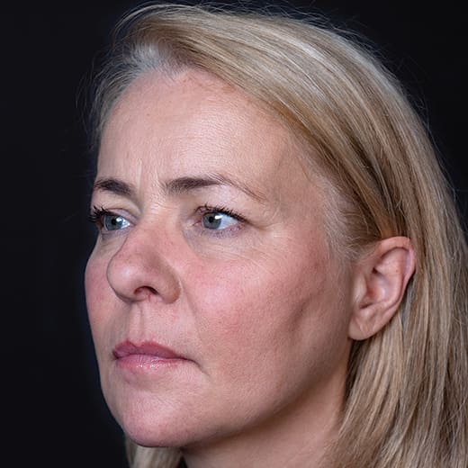 Before volumetric facelift with cheek, chin, and jawline filler, addressing jowls.