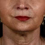 After a volumetric facelift with cheek filler, addressing marionette lines.