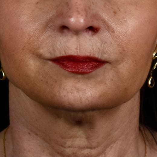 After a volumetric facelift with cheek filler, addressing marionette lines.