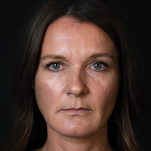 After volumetric facelift with chin and jaw filler, addressing downturned mouth corners