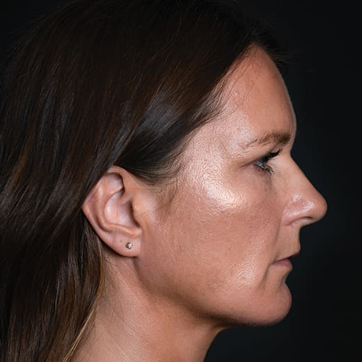 After volumetric facelift with chin and jaw filler, addressing downturned mouth corners