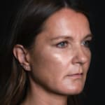 Before volumetric facelift with chin and jaw filler, addressing downturned mouth corners