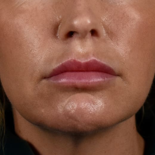 After volumetric facelift with chin and jaw fillers, chin augmentation, and jowl lift, addressing sagging neck and sagging jawline.