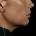 After volumetric facelift with chin and jaw fillers, chin augmentation, and jowl lift, addressing sagging neck and sagging jawline.