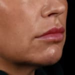 Before volumetric facelift with chin and jaw fillers, chin augmentation, and jowl lift, addressing sagging neck and sagging jawline.