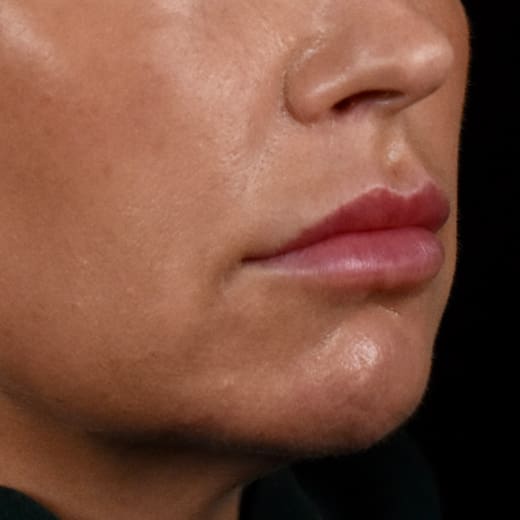 Before volumetric facelift with chin and jaw fillers, chin augmentation, and jowl lift, addressing sagging neck and sagging jawline.