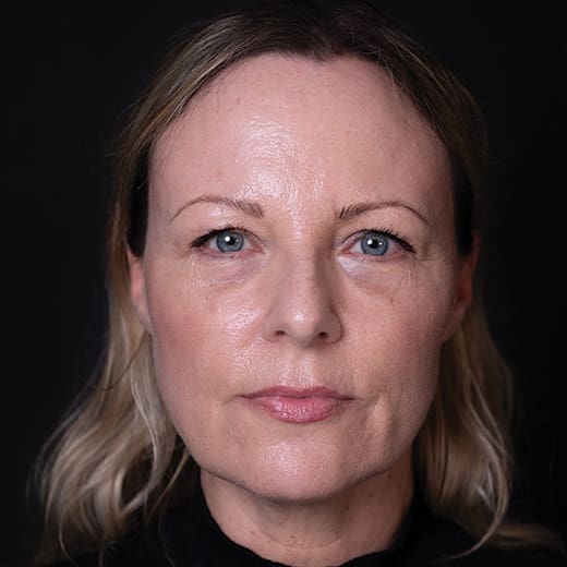 After a volumetric facelift with jowl lift, chin augmentation, and tear trough filler, addressing sagging jawline, jowls, under-eye bags, and dark circles