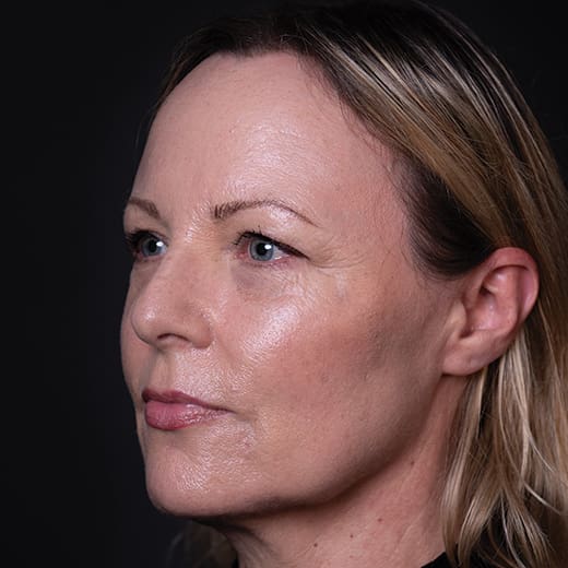 After a volumetric facelift with jowl lift, chin augmentation, and tear trough filler, addressing sagging jawline, jowls, under-eye bags, and dark circles