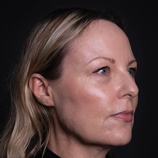 Before a volumetric facelift with jowl lift, chin augmentation, and tear trough filler, addressing sagging jawline, jowls, under-eye bags, and dark circles