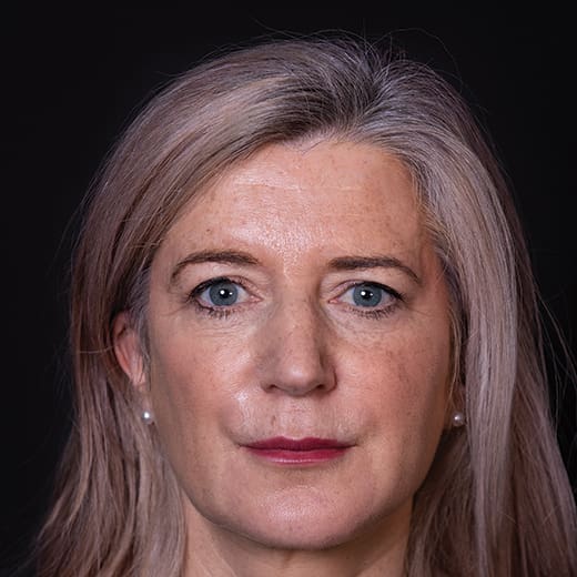 After volumetric facelift with jowl lift and chin, jaw, and cheek filler, addressing sagging cheeks and sagging jawline.