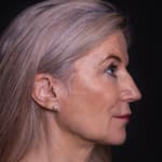 After volumetric facelift with jowl lift and chin, jaw, and cheek filler, addressing sagging cheeks and sagging jawline.