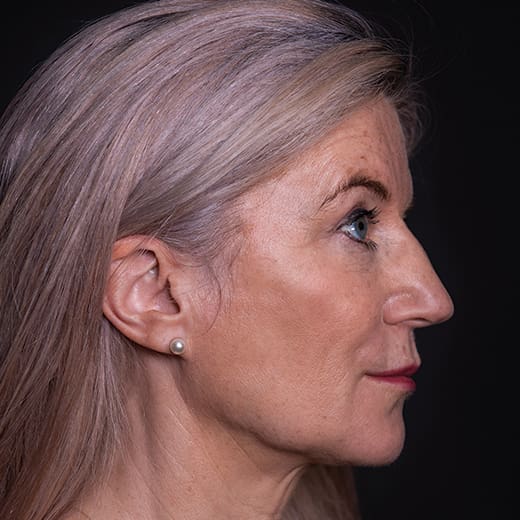 After volumetric facelift with jowl lift and chin, jaw, and cheek filler, addressing sagging cheeks and sagging jawline.