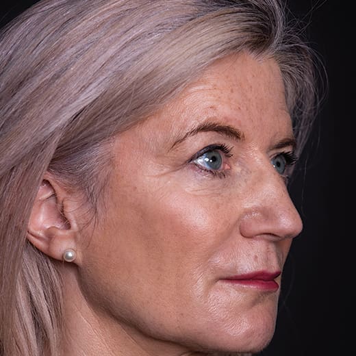 After volumetric facelift with jowl lift and chin, jaw, and cheek filler, addressing sagging cheeks and sagging jawline.