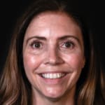 After wrinkle-relaxing injections and filler, addressing crow's feet.