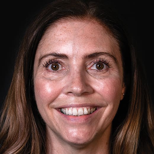 After wrinkle-relaxing injections and filler, addressing crow's feet.