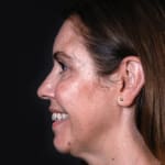 After wrinkle-relaxing injections and filler, addressing crow's feet.