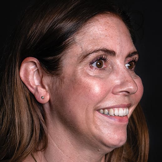 Before wrinkle-relaxing injections and filler, addressing crow's feet.