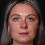 Before wrinkle-relaxing injections and fillers, addressing frown lines.