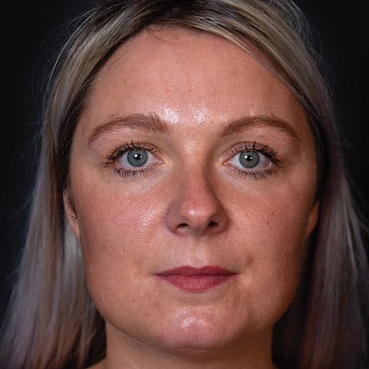 Before wrinkle-relaxing injections and fillers, addressing frown lines.