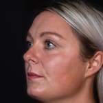 Before wrinkle-relaxing injections and fillers, addressing frown lines.