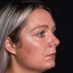 Before wrinkle-relaxing injections and fillers, addressing frown lines.