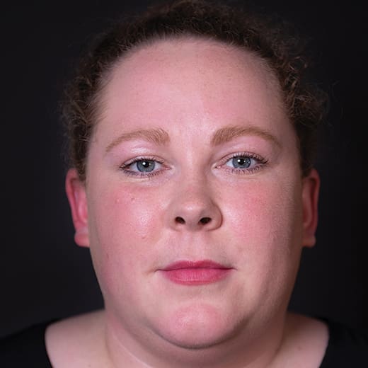 Before wrinkle-relaxing injections, addressing forehead lines.