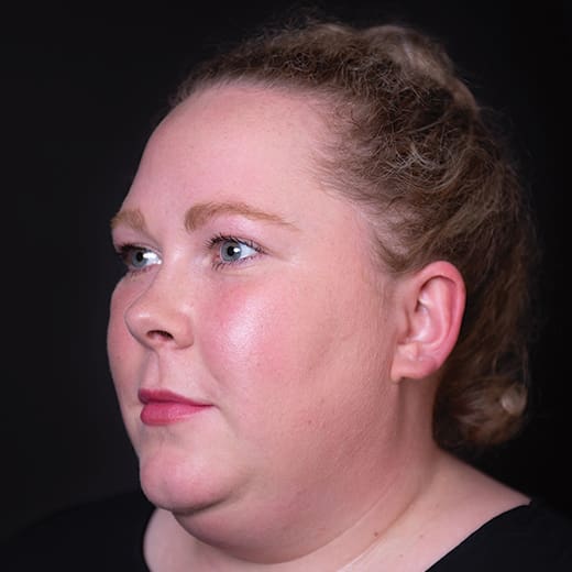 Before wrinkle-relaxing injections, addressing forehead lines.