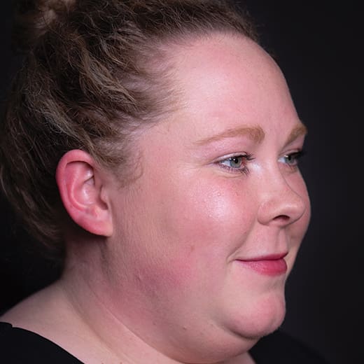 Before wrinkle-relaxing injections, addressing forehead lines.