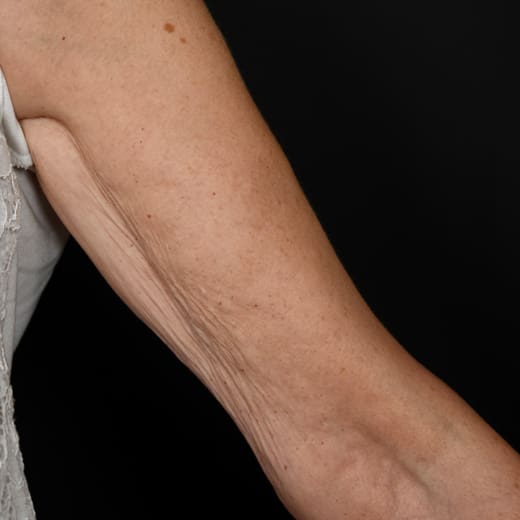 Before BBL SkinTyte treatment, addressing sagging arms (bingo wings).