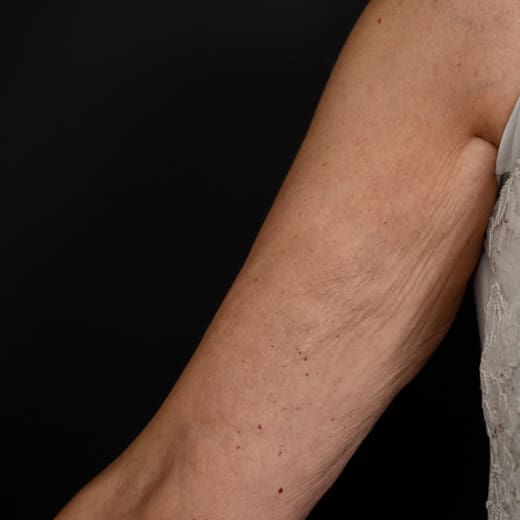 Before BBL SkinTyte treatment, addressing sagging arms (bingo wings).