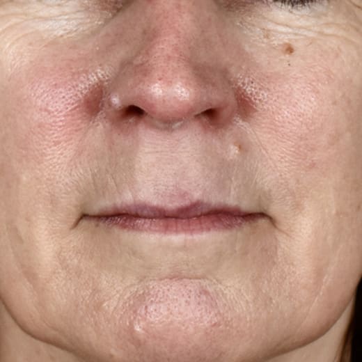 Before BBL laser treatment, addressing rosacea.