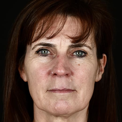 Before BBL laser treatment, addressing rosacea.