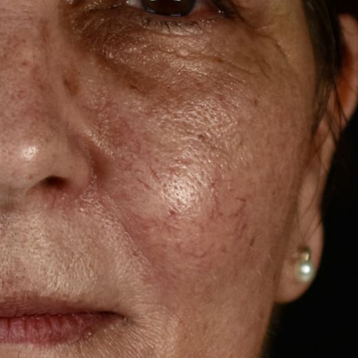 Before BBL treatment, addressing redness and broken blood vessels.
